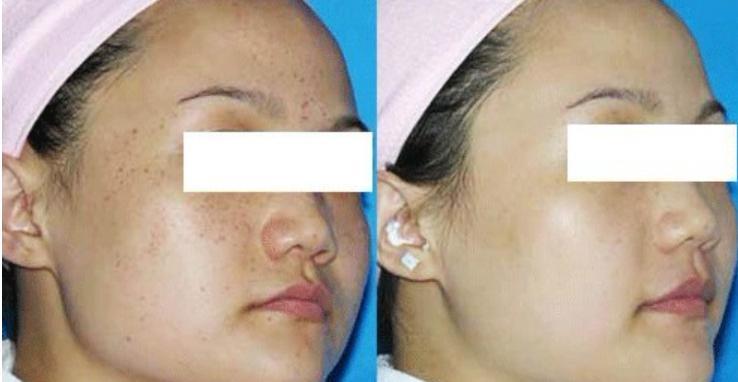 激光祛斑后需要注意的五大事項(xiàng)，激光祛斑后的五大注意事項(xiàng)詳解