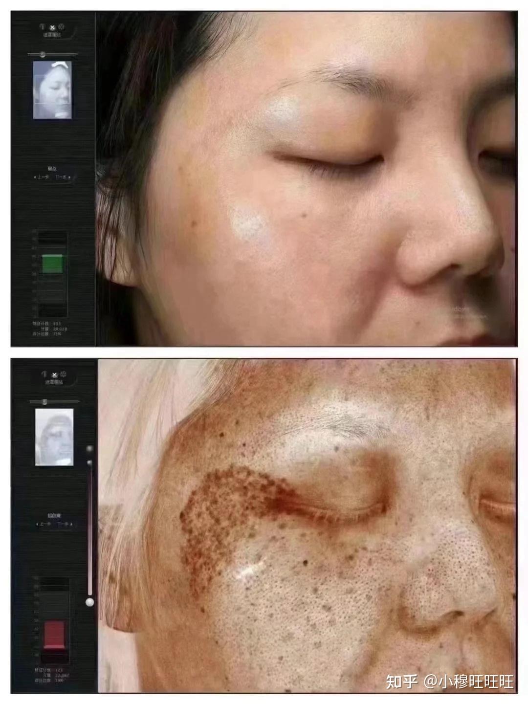 激光祛斑，選擇醫院還是美容院？全面解讀助您做出明智決策，激光祛斑，如何選擇醫院與美容院？全面解讀為您指明決策方向