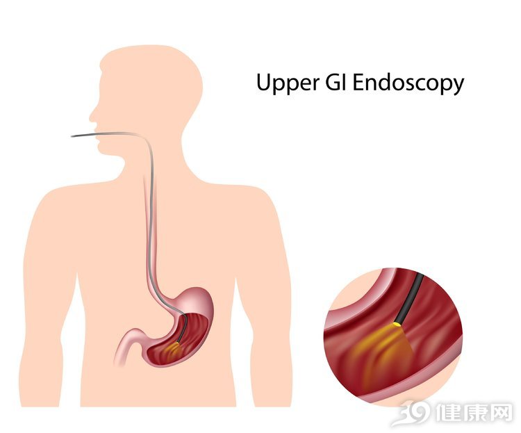 做胃鏡難受嗎?全面解析胃鏡檢查的體驗與注意事項,胃鏡檢查全面解析,體驗、難受程度及注意事項探討
