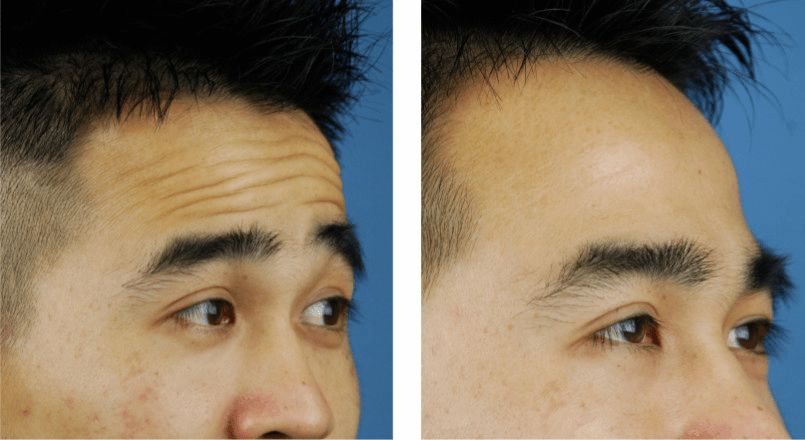 抬頭紋很重怎么去除——全面解析去除抬頭紋的方法,抬頭紋去除全攻略,有效消除頑固抬頭紋的方法