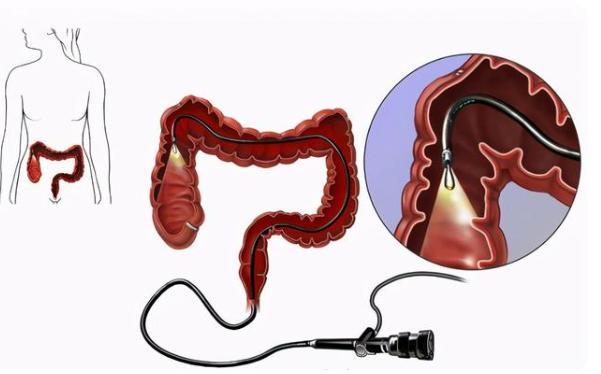 女性做腸鏡的尷尬經過,了解、準備與應對,女性腸鏡經歷,尷尬、準備與應對之道