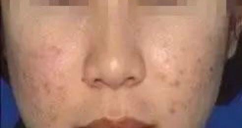 有什么辦法可以去除痘印?全面解析痘印消除方法,全面解析,痘印消除方法與技巧