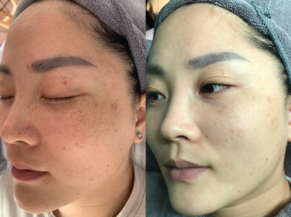 正規(guī)醫(yī)院祛斑效果深度解析,安全與效果的雙重保障,正規(guī)醫(yī)院祛斑效果深度解析,雙重保障下的安全與效果體驗