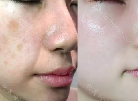 正規(guī)醫(yī)院祛斑效果深度解析,安全與效果的雙重保障,正規(guī)醫(yī)院祛斑效果深度解析,雙重保障下的安全與效果體驗