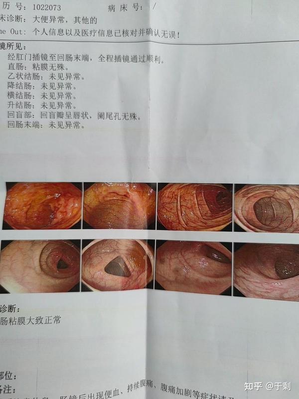 腸鏡檢查,一次不愉快的經歷,腸鏡檢查,一次難忘的不愉快體驗