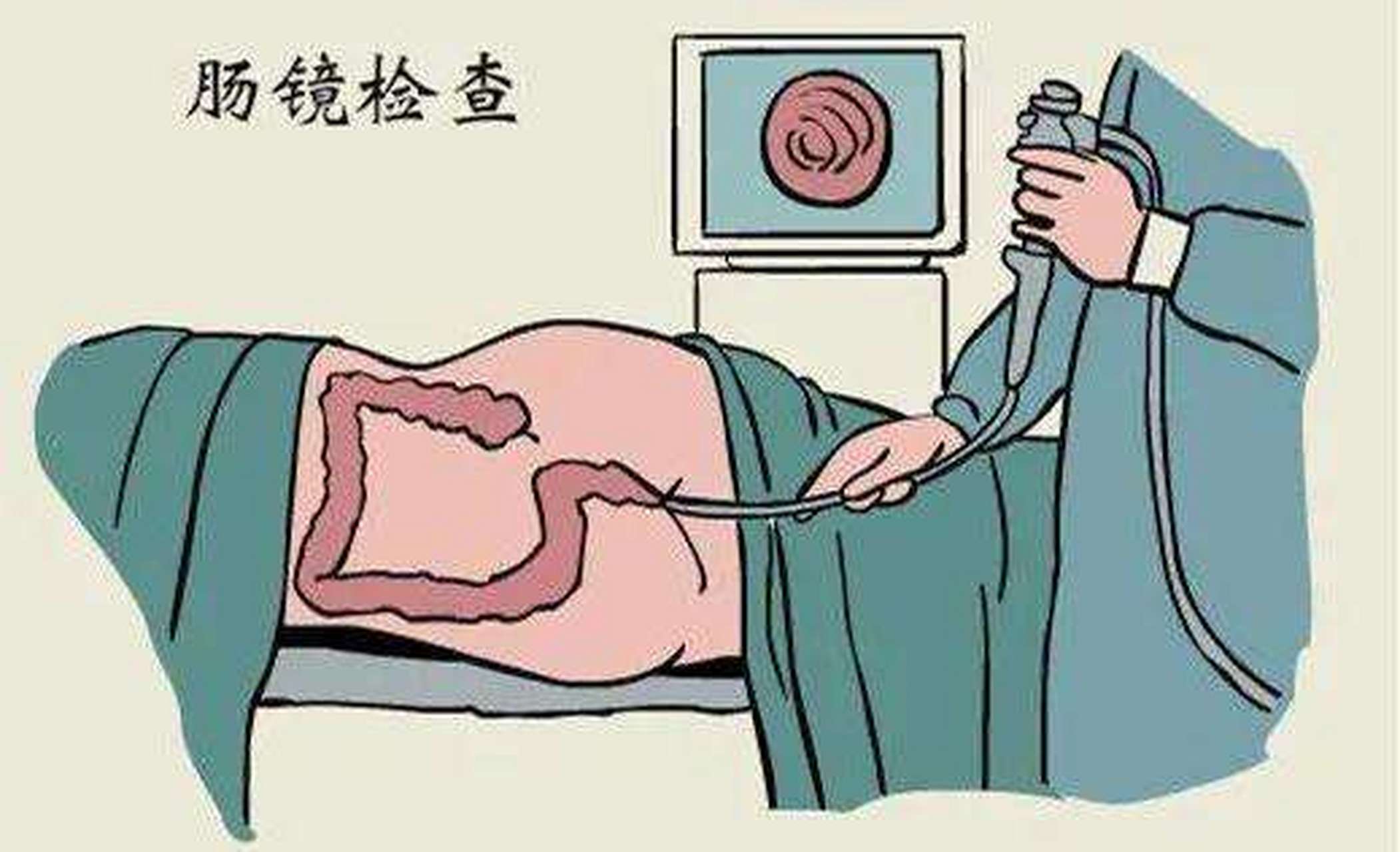 腸鏡檢查,一次不愉快的經歷,腸鏡檢查,一次難忘的不愉快體驗