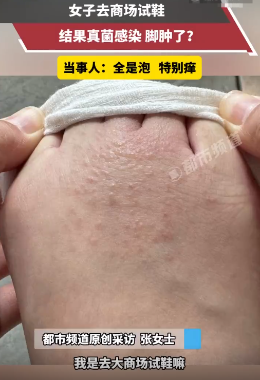 腳上怎么分辨是濕疹還是腳氣——一篇文章帶你了解二者的區(qū)別,腳上濕疹與腳氣如何區(qū)分?一篇文章詳解二者區(qū)別。