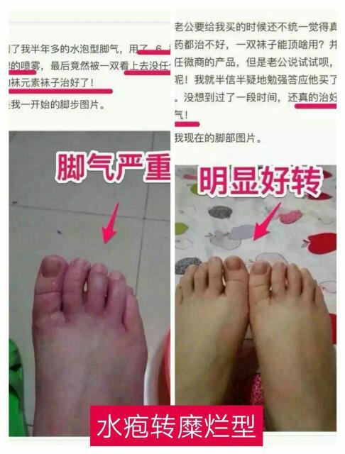 腳上怎么分辨是濕疹還是腳氣——一篇文章帶你了解二者的區(qū)別,腳上濕疹與腳氣如何區(qū)分?一篇文章詳解二者區(qū)別。