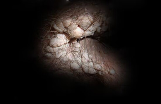 如何判斷得了肛門疣——癥狀、診斷與應對策略,肛門疣的癥狀、診斷及應對策略指南