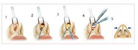 微調(diào)鼻子需要多少錢，全面解析費(fèi)用因素與注意事項，微調(diào)鼻子費(fèi)用全解析，費(fèi)用因素與注意事項，需要多少錢？