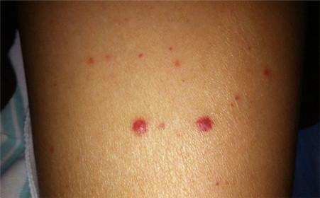 血痣和紅痣的區別圖片,深入了解兩種皮膚狀況,血痣與紅痣的區別詳解,專業圖片解析,深入了解兩種皮膚狀況特征