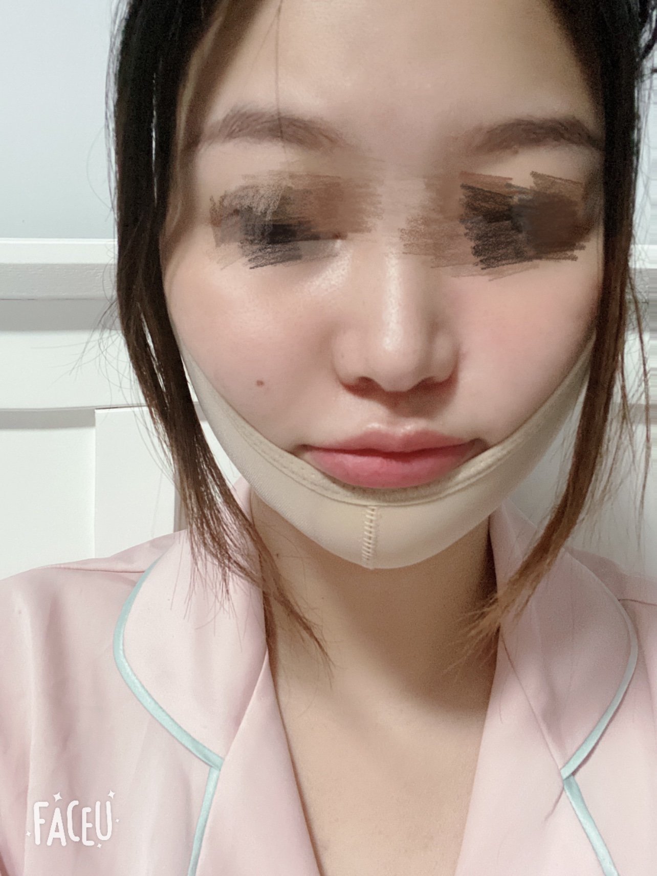 面部吸脂十天后的變化,圖片與經驗分享,面部吸脂十天,變化、圖片與經驗分享