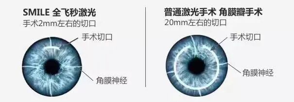 全飛秒和半飛秒哪個更好,深度解析兩種近視矯正技術的優劣,全飛秒與半飛秒近視矯正技術對比,深度解析優劣差異