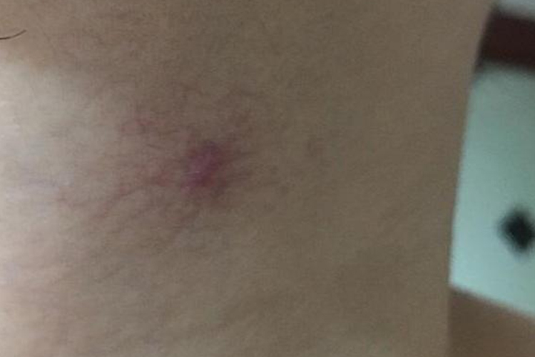 肝癌身上出現紅點圖片,癥狀解析與關注,肝癌身上紅點解析,癥狀、圖片及關注重點