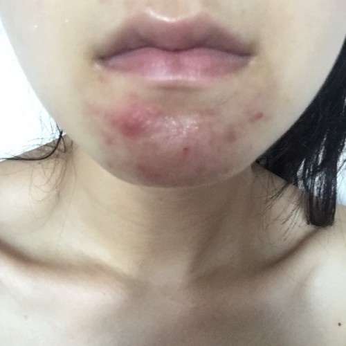 痘痘長不出來,肉里硬硬的,原因解析與應(yīng)對建議,痘痘無法冒出表面,內(nèi)部硬結(jié)成因解析及應(yīng)對之策