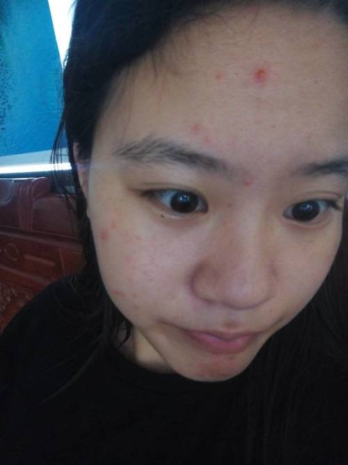 痘痘長不出來,肉里硬硬的,原因解析與應(yīng)對建議,痘痘無法冒出表面,內(nèi)部硬結(jié)成因解析及應(yīng)對之策