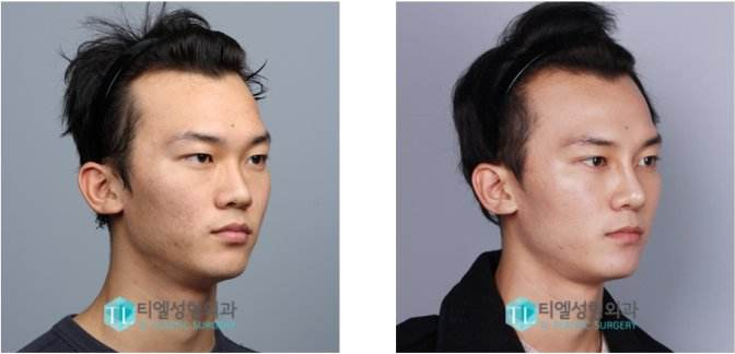 男士整容前后圖片，探索變化，揭示真實，男士整容前后對比，探索變化，揭示真實之美