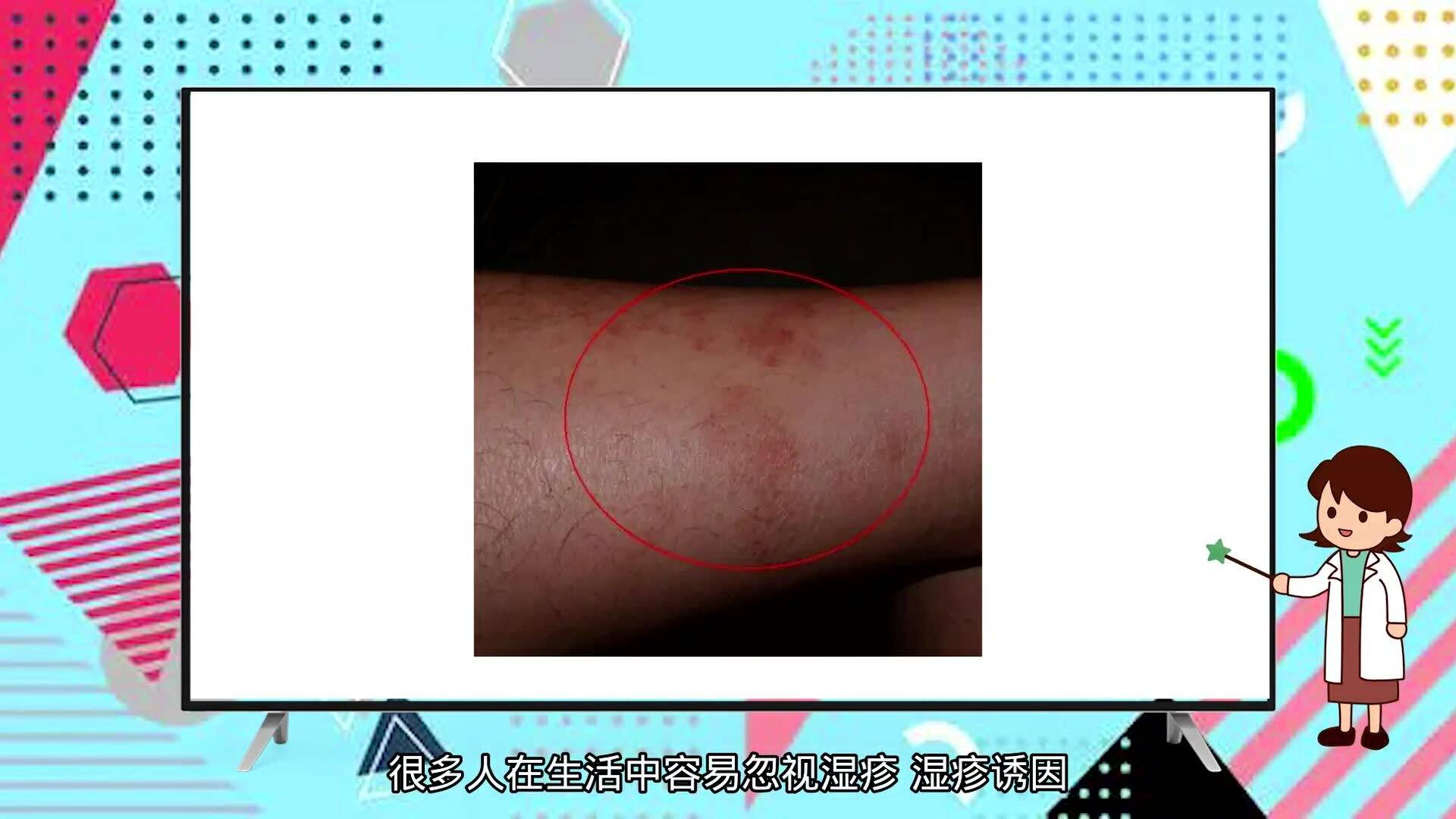 蕁麻疹夜晚止癢妙招,讓你遠離瘙癢困擾,蕁麻疹夜晚止癢小妙招,告別瘙癢煩惱