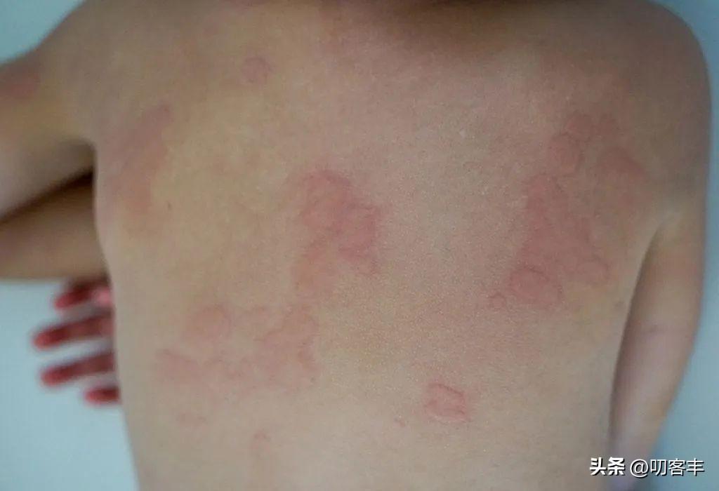 成人蕁麻疹的成因及防治策略,成人蕁麻疹成因與防治策略解析