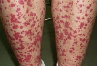 皮膚上有小紅點像血點,原因、診斷與處理方法,皮膚小紅點解析,成因、診斷及應對方法