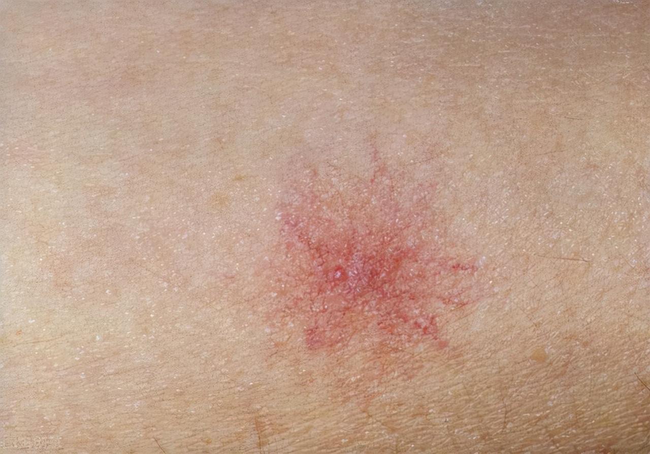 皮膚上有小紅點像血點,原因、診斷與處理方法,皮膚小紅點解析,成因、診斷及應(yīng)對方法