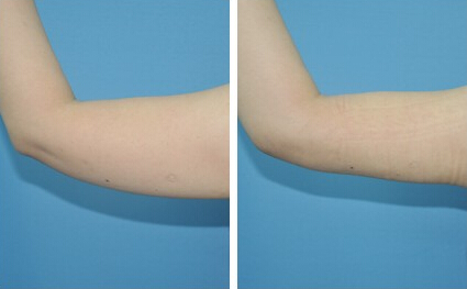 手臂抽脂價格一覽表——打造纖細玉臂的必備指南，手臂抽脂價格詳解，打造纖細玉臂的必備指南