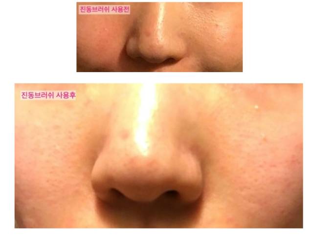 激光美白,讓你膚色煥新,白幾個度不再是夢,激光美白,重塑膚色,白皙煥新不再是夢