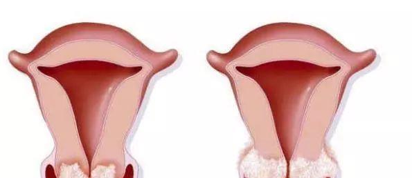 女性HPV初期感染的圖片及其相關知識科普,女性HPV初期感染圖片與知識科普,了解、預防與治療