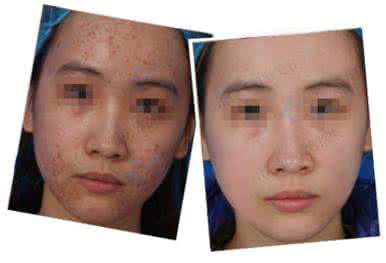 激光祛痘痘有效果嗎,深度解析與全面理解,激光祛痘效果深度解析與全面理解指南