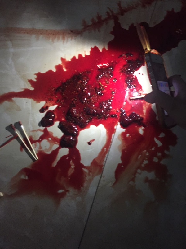 突然拉血了,原因及應對措施,突然拉血原因與應對措施解析