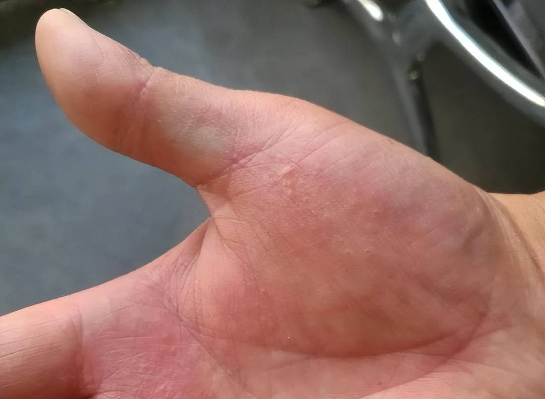 手上起小水泡圖片,原因、治療與預防,手上起小水泡,圖片詳解、成因、治療與預防方法