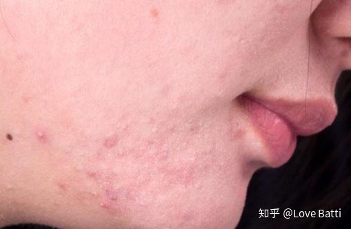 如何判斷臉上是否有螨蟲,全面解析與應對建議,全面解析,如何判斷臉上是否有螨蟲及應對建議