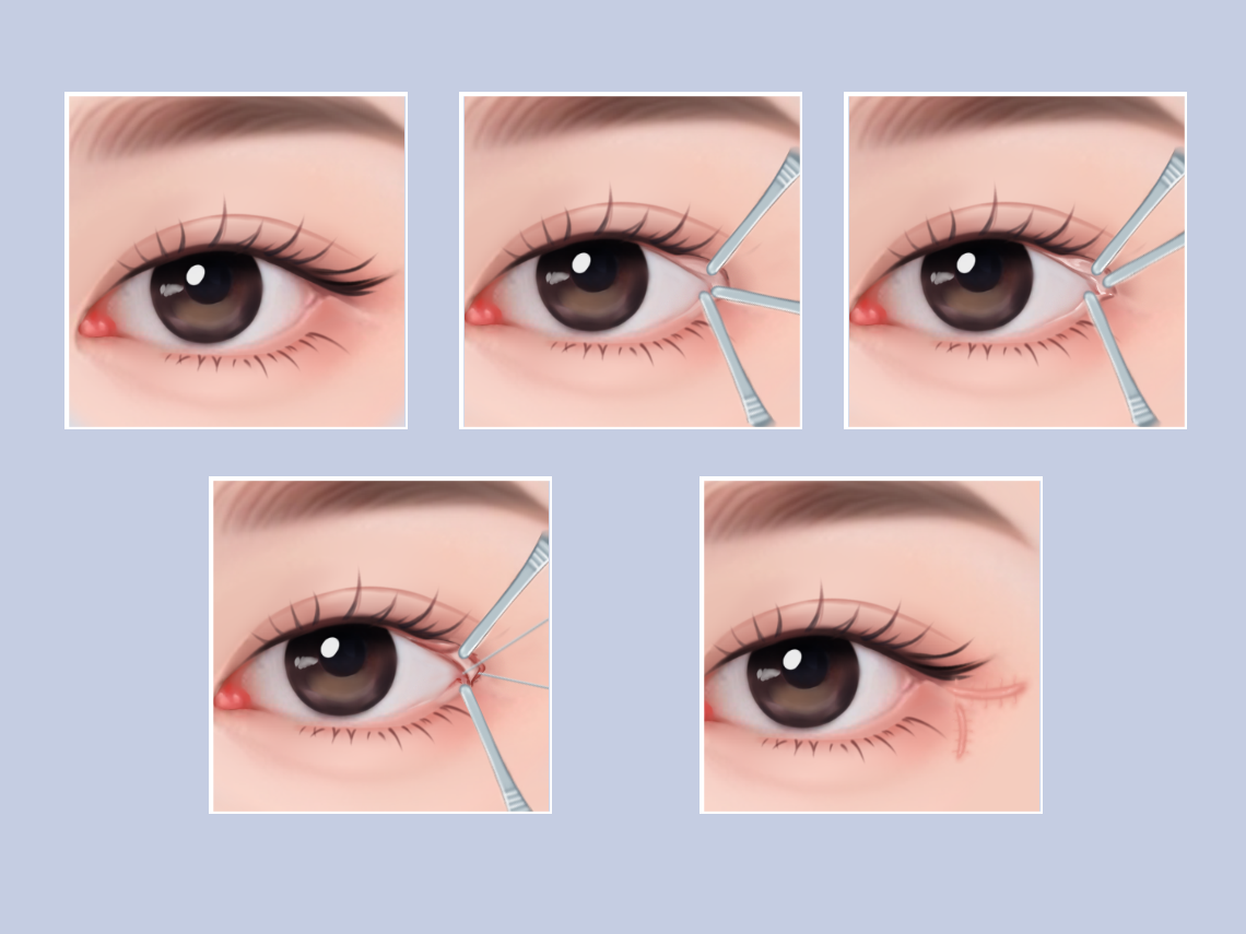 如何讓眼睛變大——全方位指南,全方位指南,讓眼睛變大的秘訣與方法