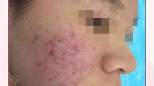 治療痤瘡的費用分析,了解花費多少以及背后的因素,治療痤瘡的費用詳解,了解花費背后的因素